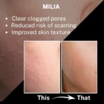 HOUSE OF BEAUTY Milia Serum with Azelaic Acid, Niacinamide, Salicylic Acid for Whiteheads, Bumps and Milia, Face, Healthy Skin (15ml, Pack of 1) - Image 4