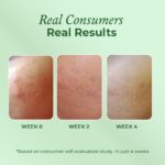 The Pink Foundry Acne Moisturiser I Treats & Prevents Breakout, Soothes Redness & Irritation I Gel Moisturiser for Normal, Sensitive, Oily, Combination Skin 50ml - Image 4