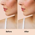 FURR by Pee Safe Acnes Patches For Pimples | 12 Hydrocolloid Acne Relief Patches - 3 Sizes | Made with Ayurvedic Ingredients | Anti Inflammatory | Reduces Acne, Spots and Blemishes - Image 8